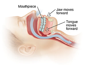 Do mouth guards help with sleep apnea？