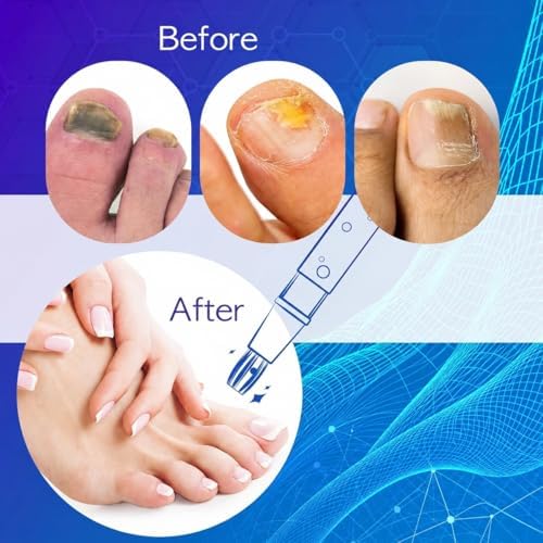 Neomen Nail Renewal Pen for Discolored, Damaged Nails – Toenails & Fingernails, 3 Count