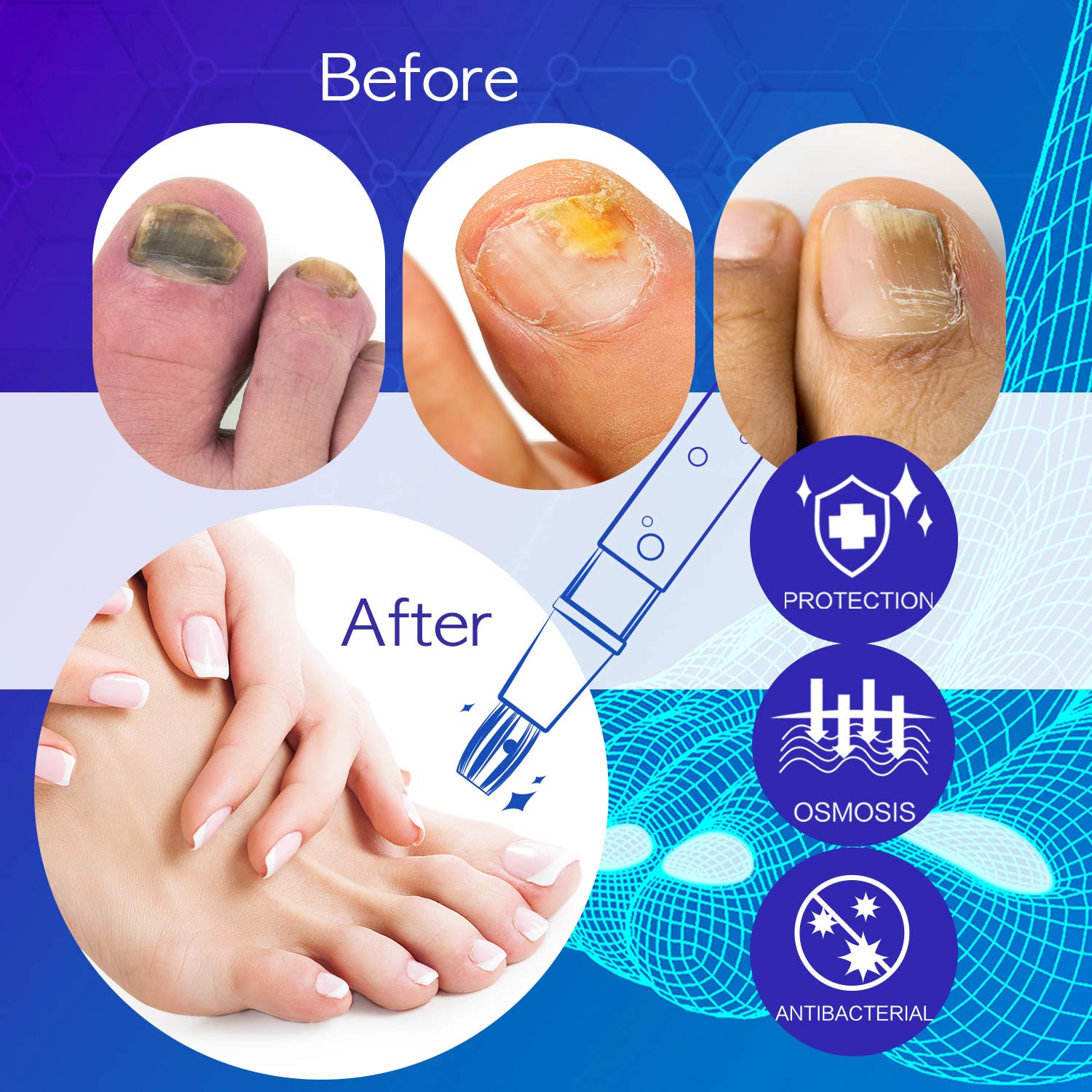 Professional Fungal Nail Treatment Cure Stop Hand Toenail Foot Fungus  Infections | eBay